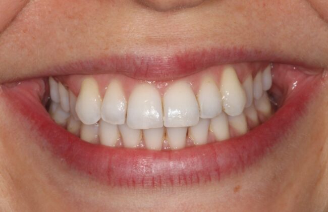 Before (Teeth)