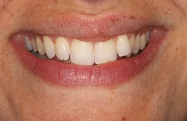 Before (Teeth)