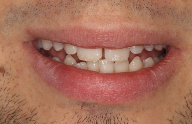 Before (Teeth)