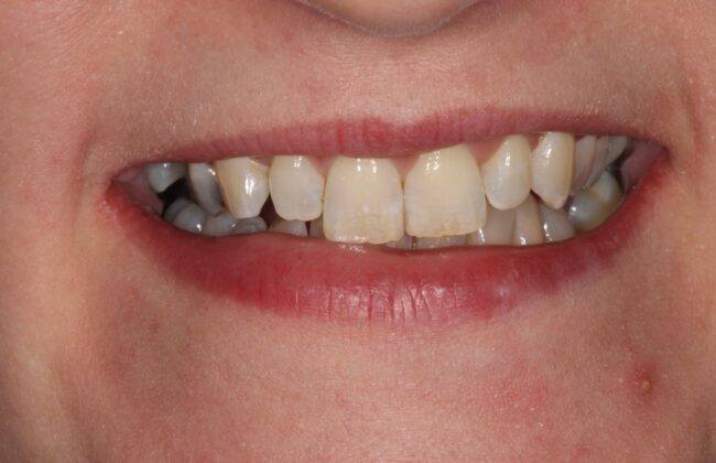 Before (Teeth)