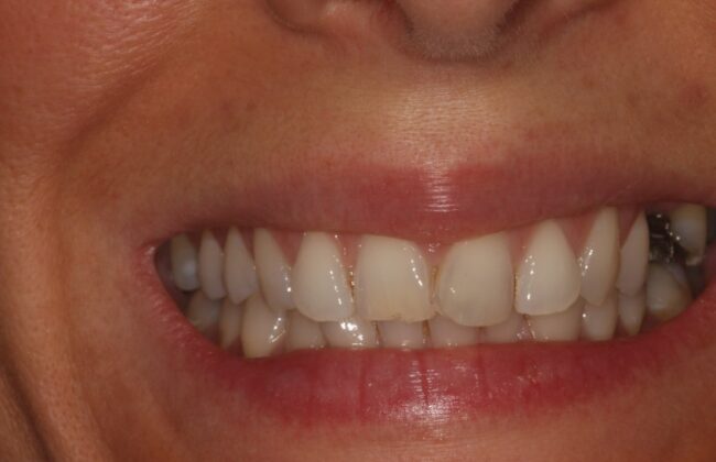 Before (Teeth)
