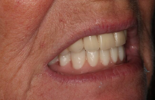 Before (Teeth)