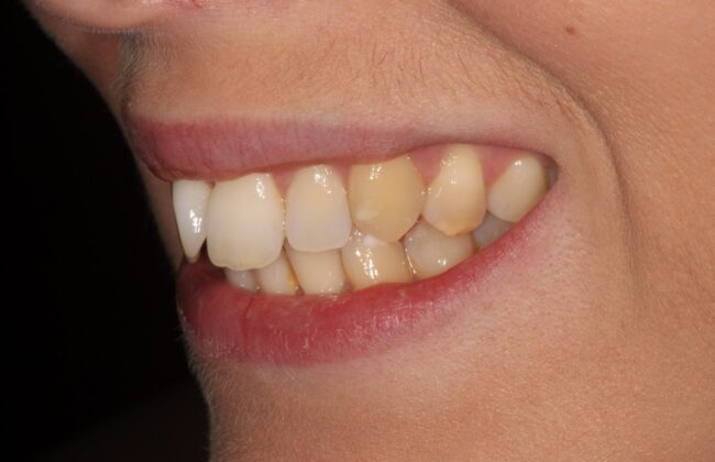 Before (Teeth)