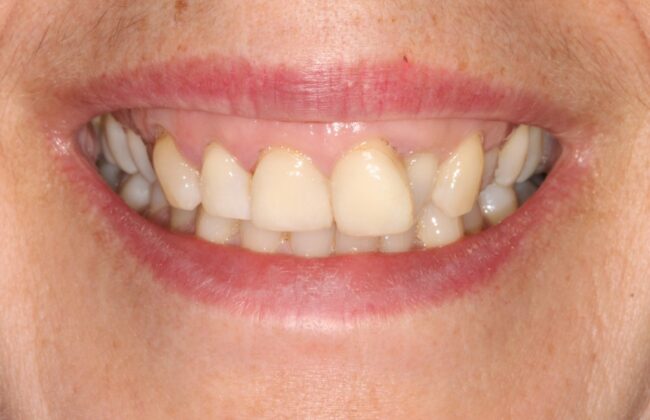 Before (Teeth)