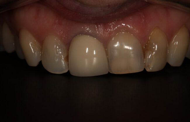Before (Teeth)
