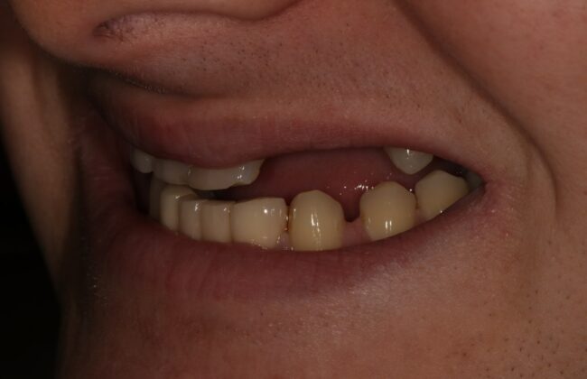 Before (Teeth)