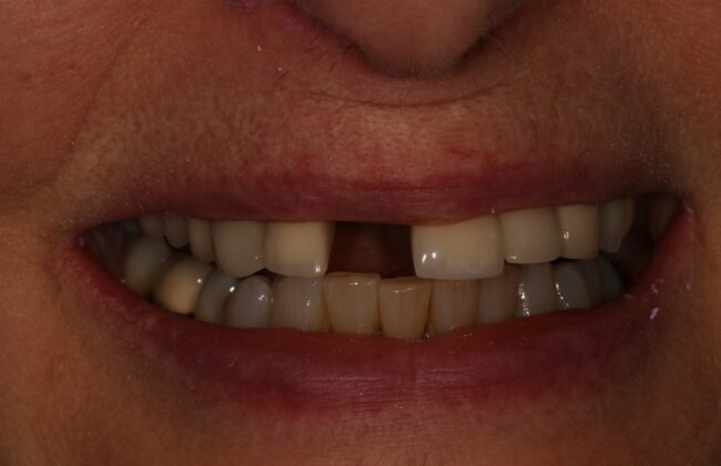 Before (Teeth)