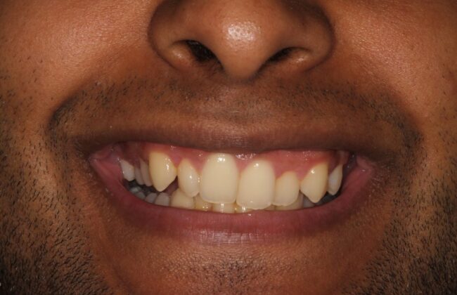 Before (Teeth)