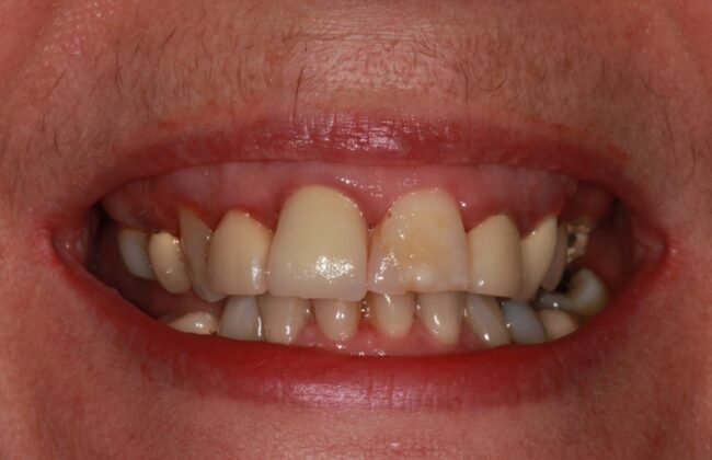 Before (Teeth)
