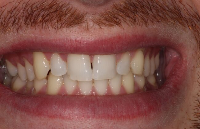 Before (Teeth)