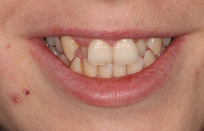 Before (Teeth)