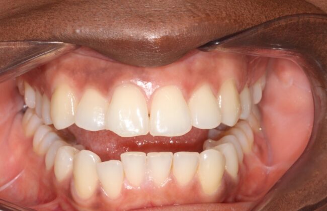 Before (Teeth)