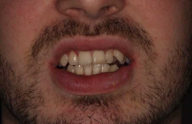 Before (Teeth)
