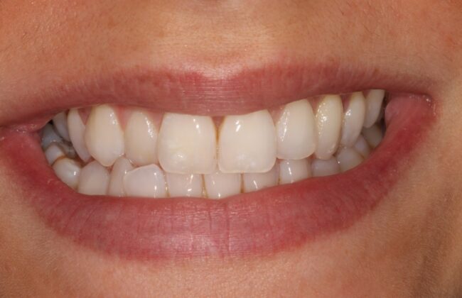 Before (Teeth)