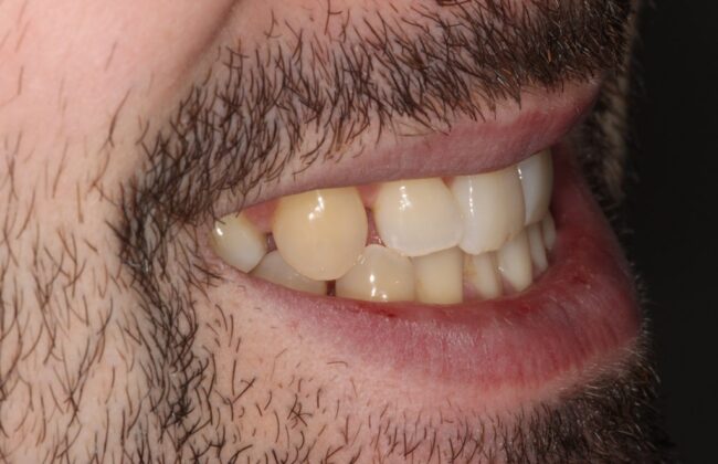 Before (Teeth)