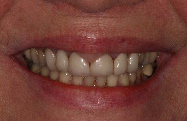 Before (Teeth)