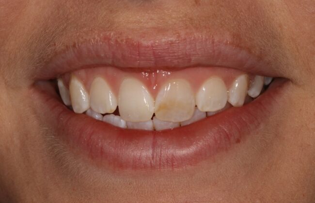 Before (Teeth)