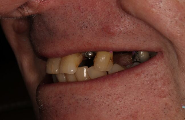 Before (Teeth)