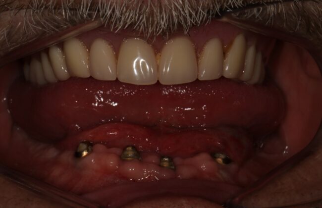Before (Teeth)