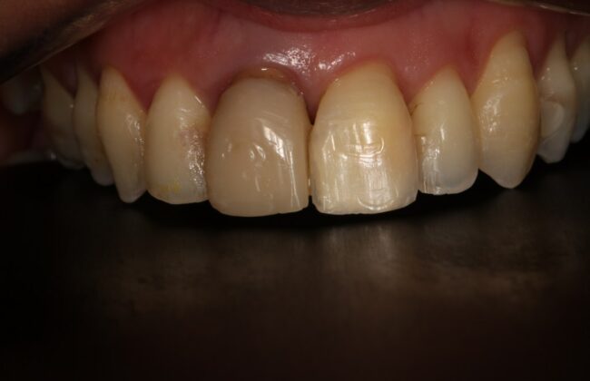 Before (Teeth)