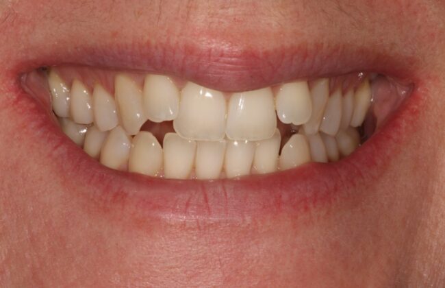 Before (Teeth)