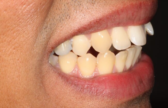 Before (Teeth)