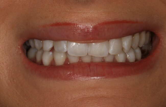 Before (Teeth)