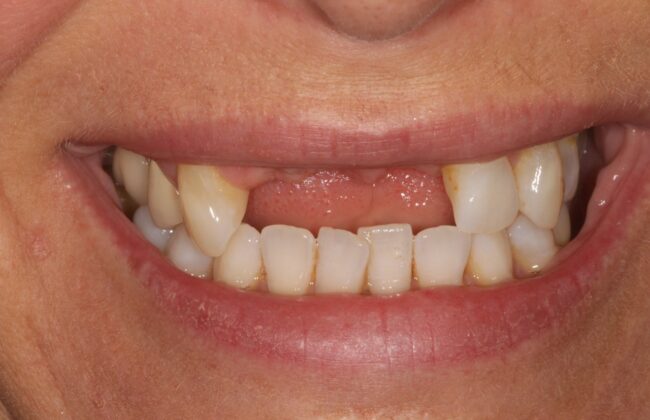 Before (Teeth)