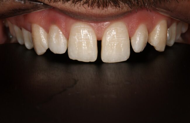 Before (Teeth)