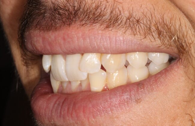 Before (Teeth)