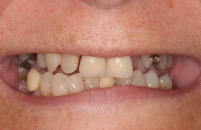 Before (Teeth)