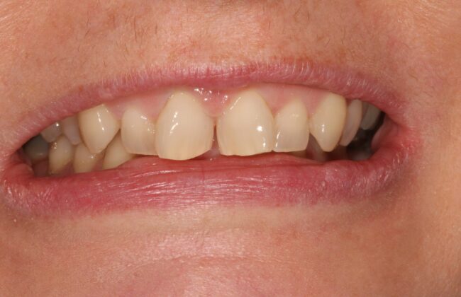 Before (Teeth)