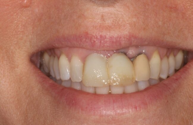 Before (Teeth)