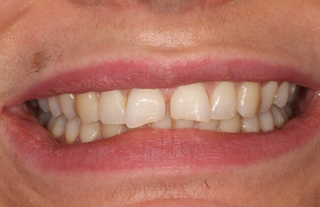 Before (Teeth)