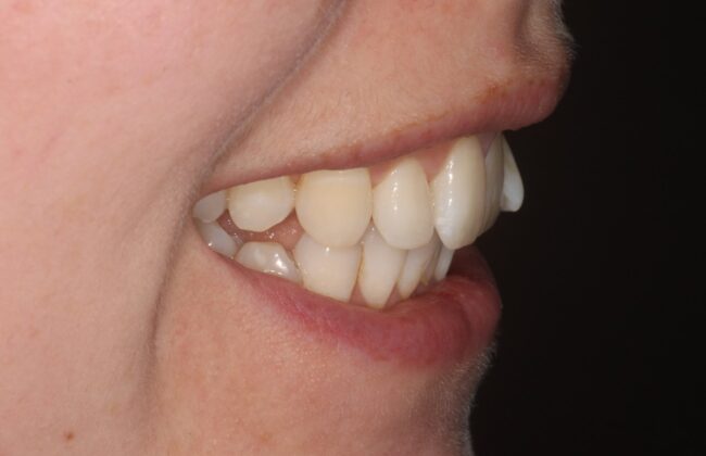 Before (Teeth)