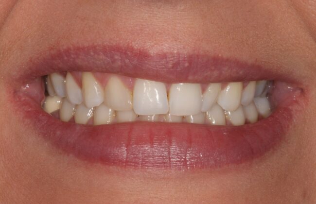 Before (Teeth)