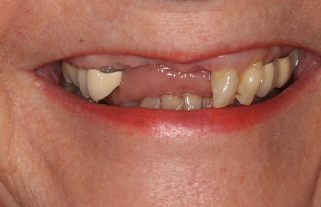 Before (Teeth)