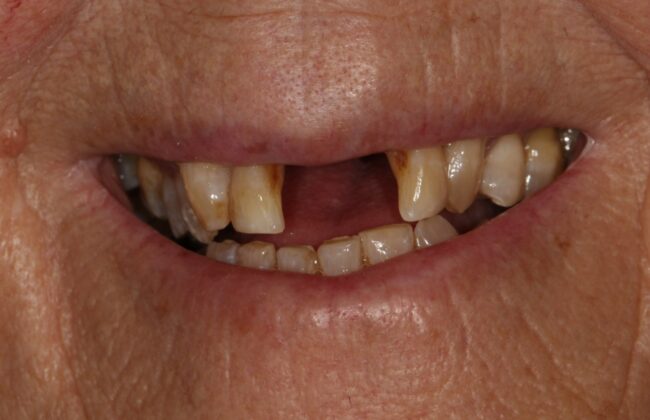 Before (Teeth)