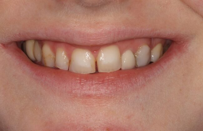 Before (Teeth)
