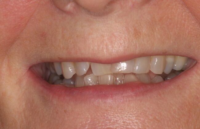Before (Teeth)