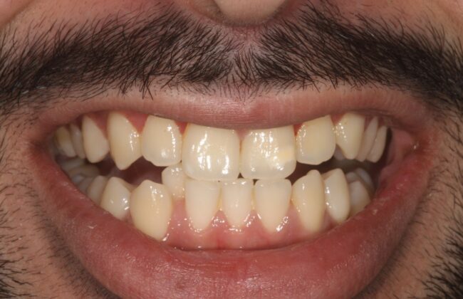 Before (Teeth)