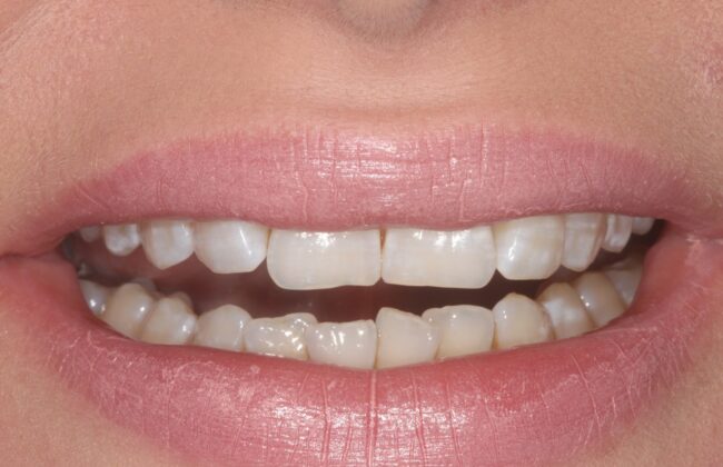 Before (Teeth)