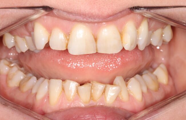 Before (Teeth)