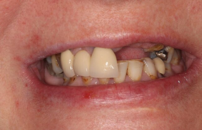 Before (Teeth)