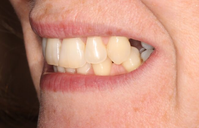 Before (Teeth)