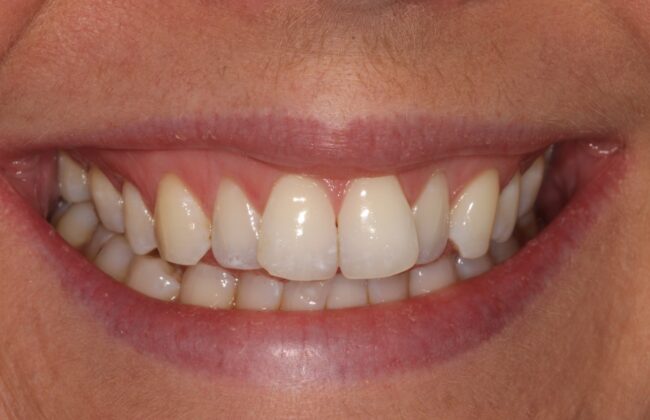 Before (Teeth)