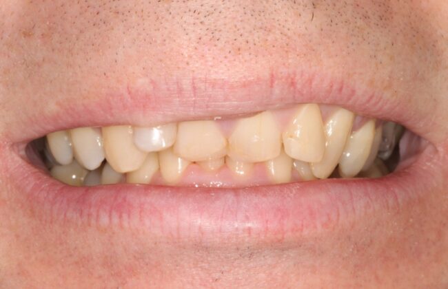 Before (Teeth)