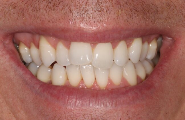Before (Teeth)