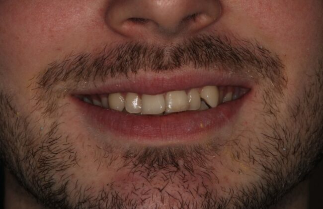 Before (Teeth)