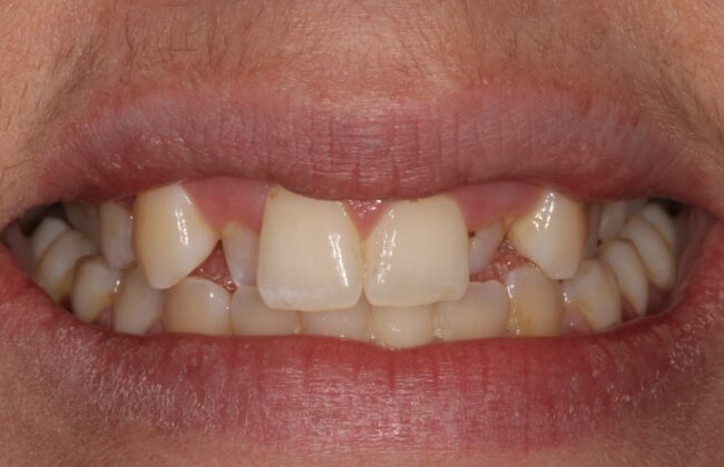 Before (Teeth)